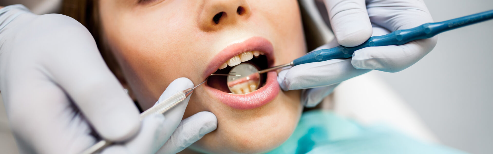How Tooth-Colored Fillings Lewisville TX Enhance Your Smile